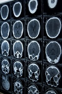 workplace brain injury lawyer El Paso, TX faqs